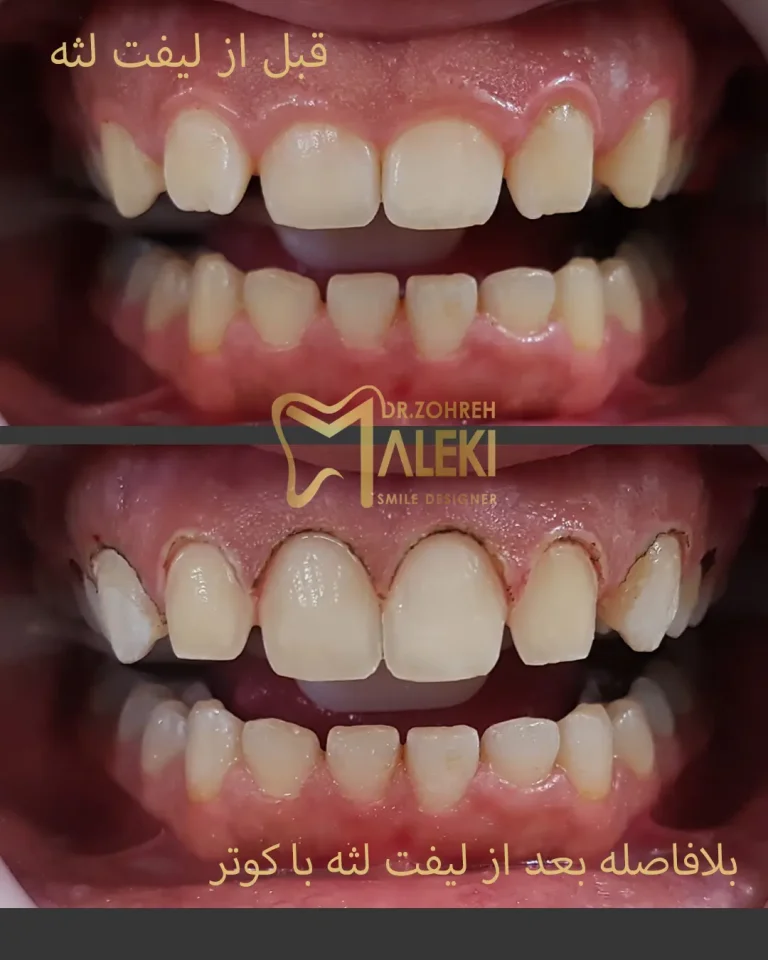 لیفت لثه در اصفهان