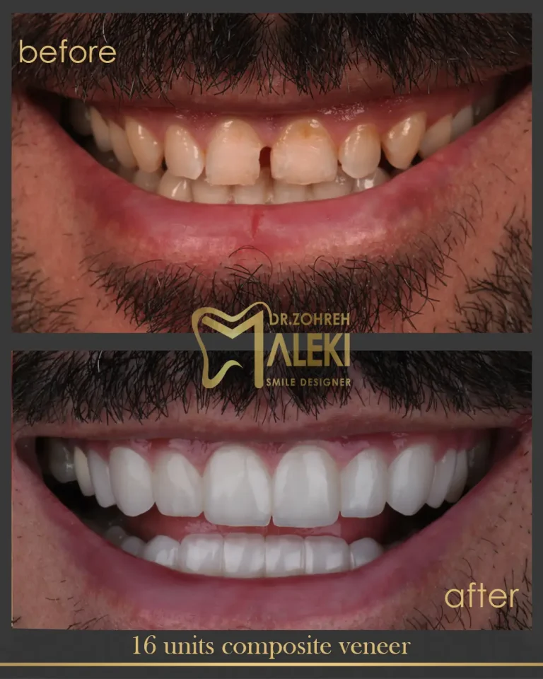 کامپوزیت ونیر دندان در اصفهان