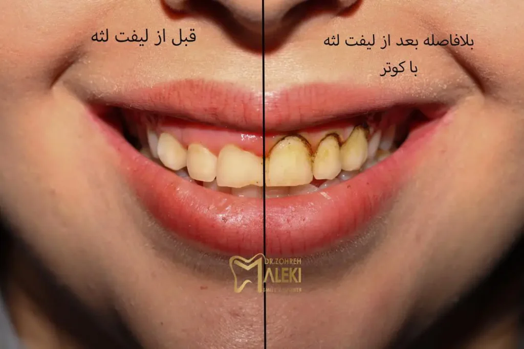 لیفت لثه در اصفهان