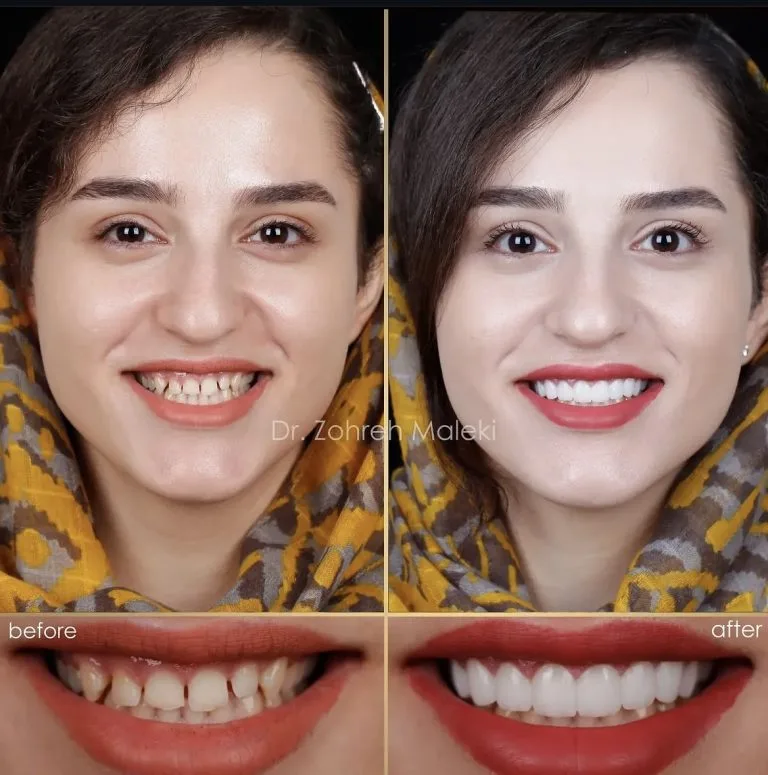 کامپوزیت ونیر دندان در اصفهان