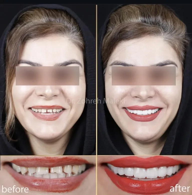 کامپوزیت ونیر دندان در اصفهان