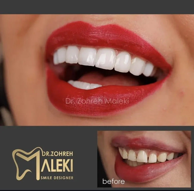 کامپوزیت ونیر دندان در اصفهان