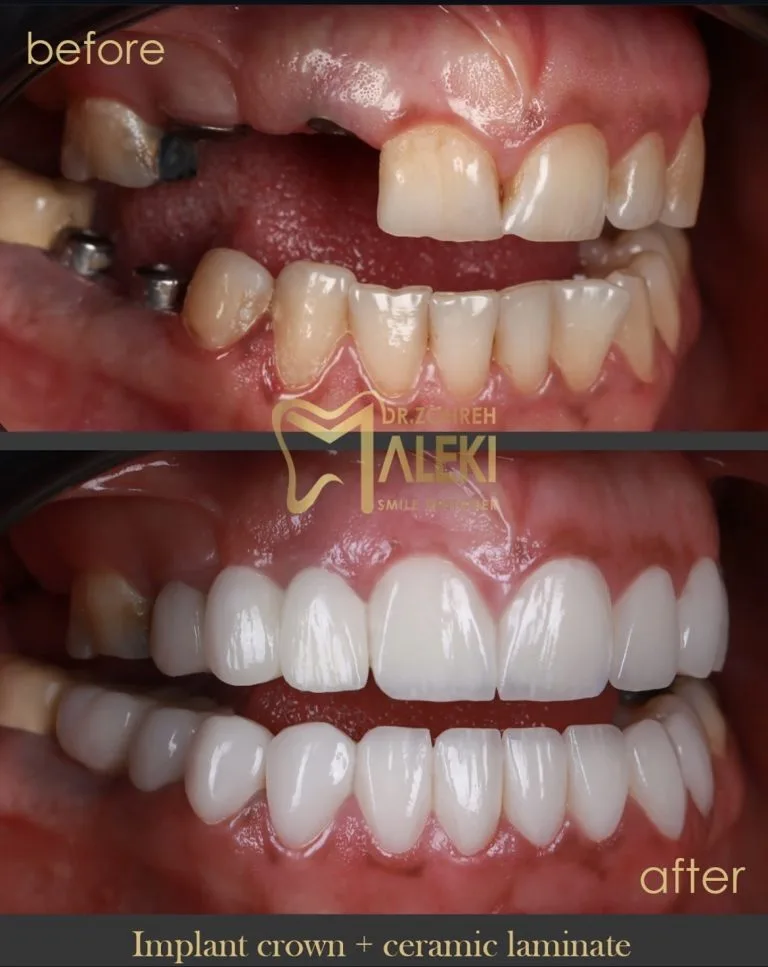 لمینت سرامیکی دندان در اصفهان