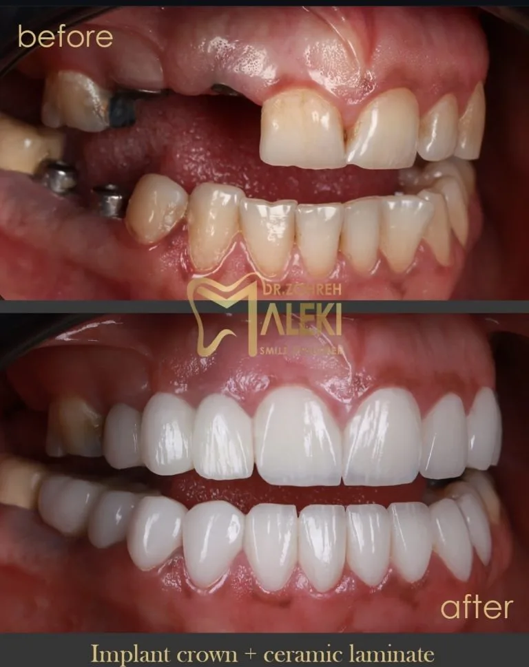 لمینت سرامیکی دندان در اصفهان