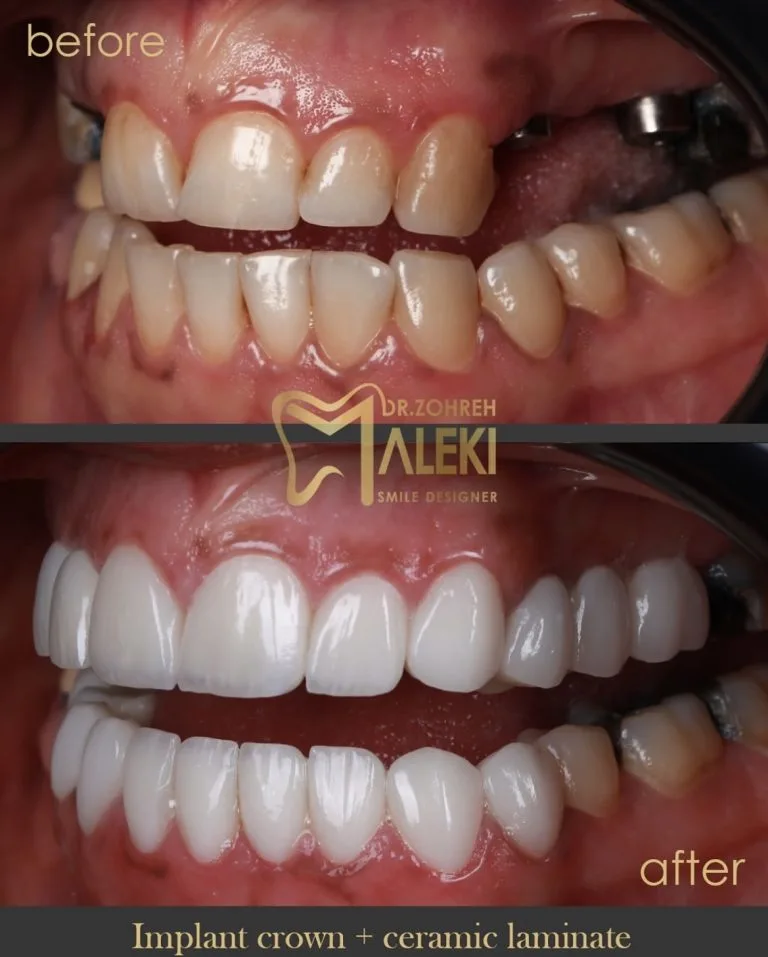 لمینت سرامیکی دندان در اصفهان