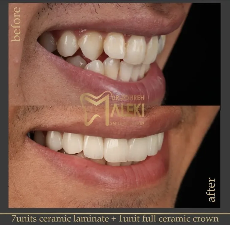 لمینت سرامیکی دندان در اصفهان