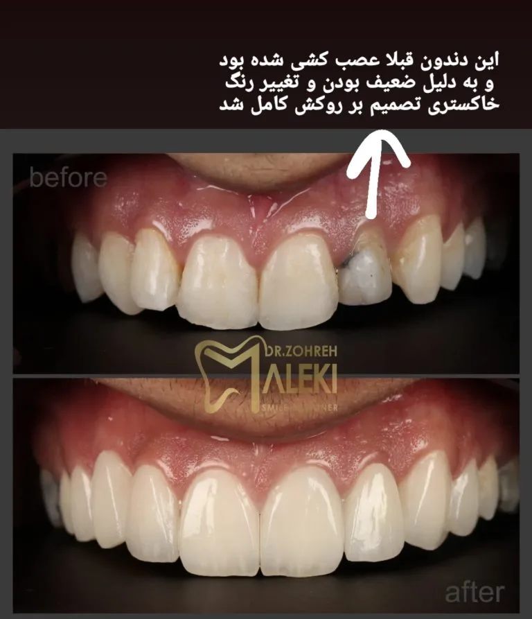 روکش های تمام سرامیک در اصفهان