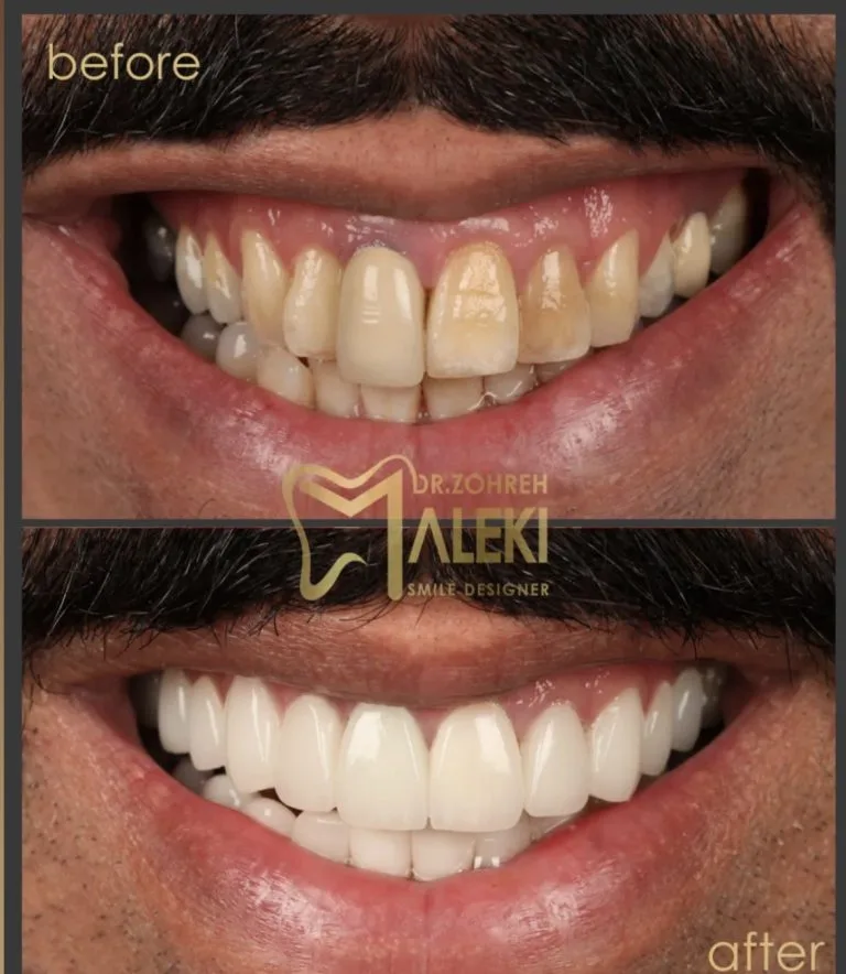 روکش های تمام سرامیک در اصفهان