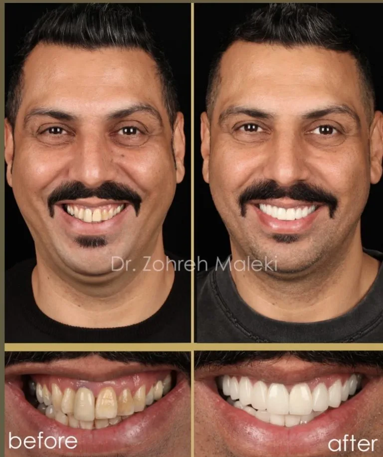 روکش های تمام سرامیک در اصفهان