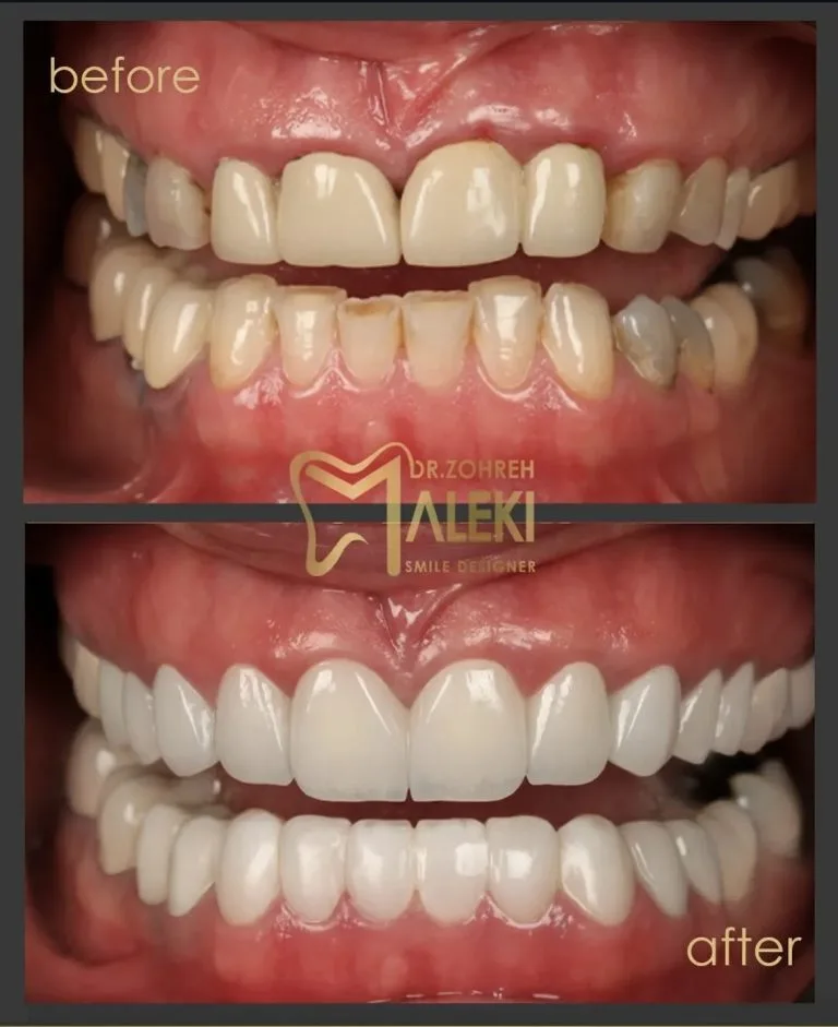 روکش های تمام سرامیک در اصفهان