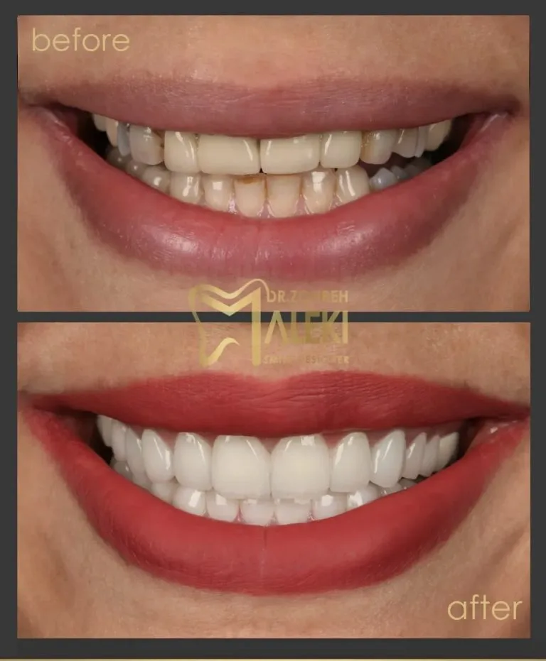 روکش های تمام سرامیک در اصفهان