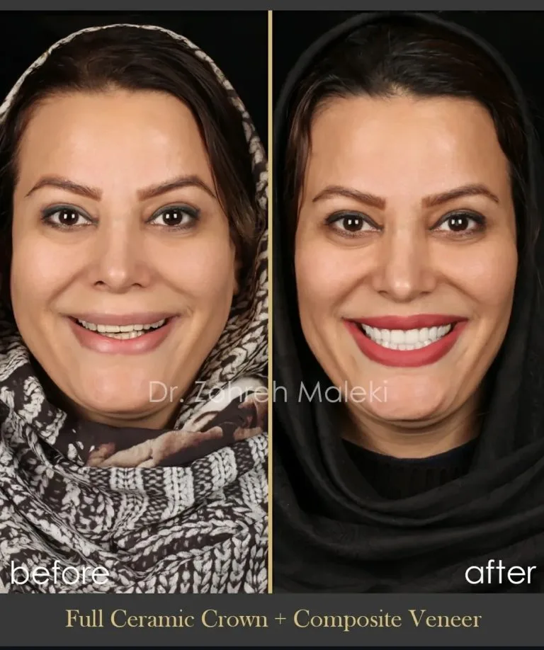 روکش های تمام سرامیک در اصفهان