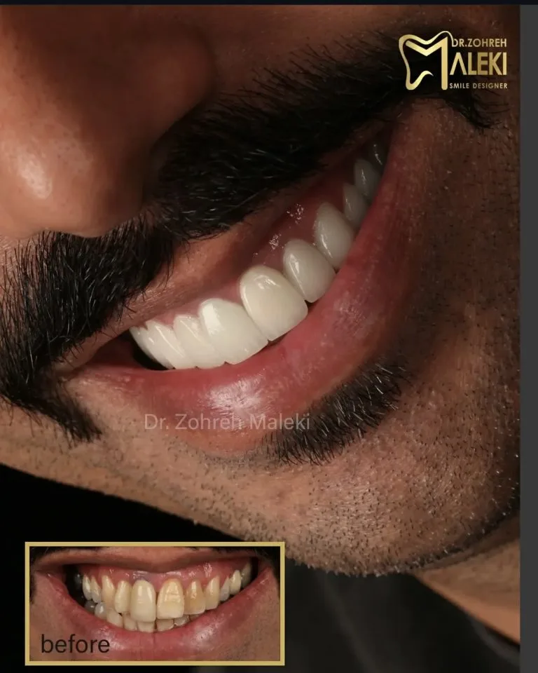 لیفت لثه در اصفهان