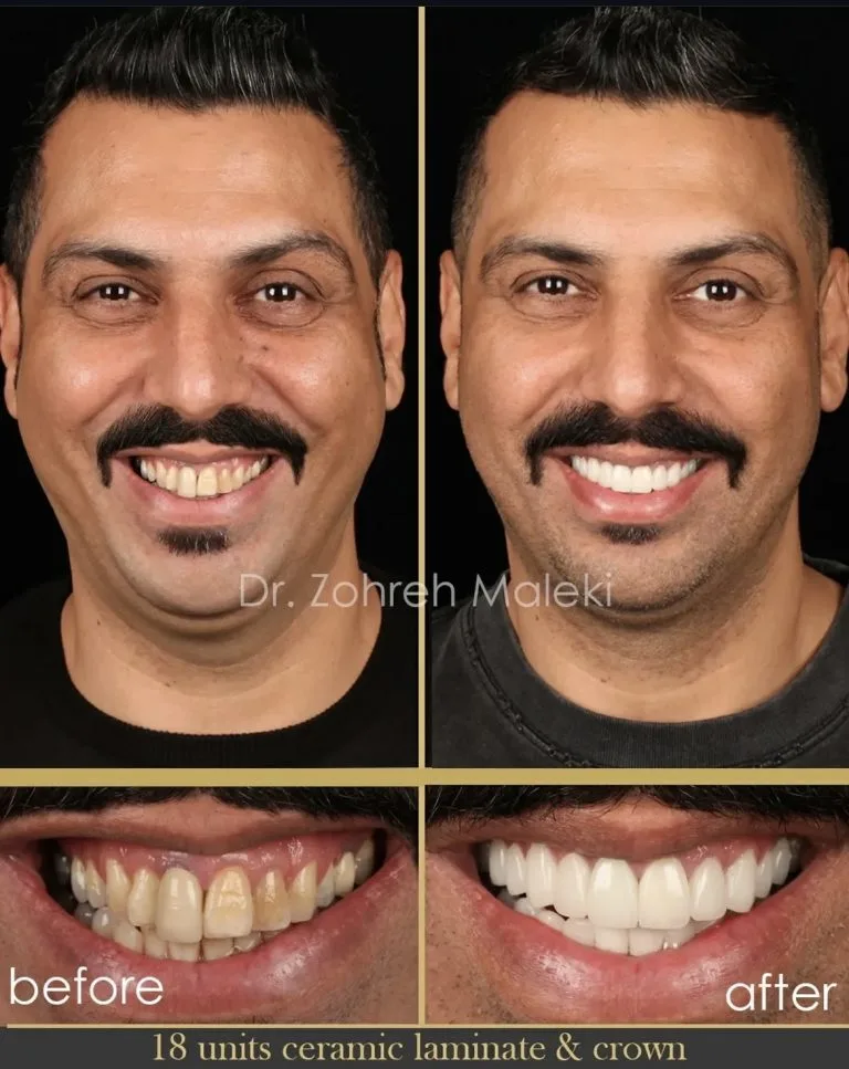 لیفت لثه در اصفهان
