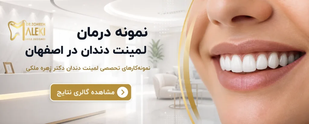 لمینت دندان چیست؟