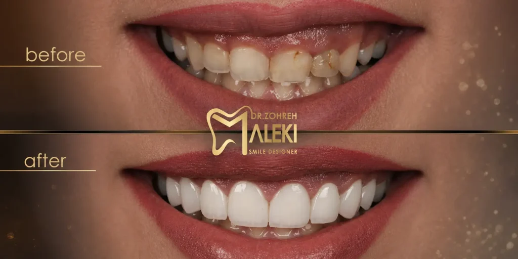 لمینت دندان چیست؟