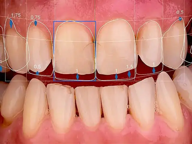 طراحی لبخند دیجیتال (DSD) چیست