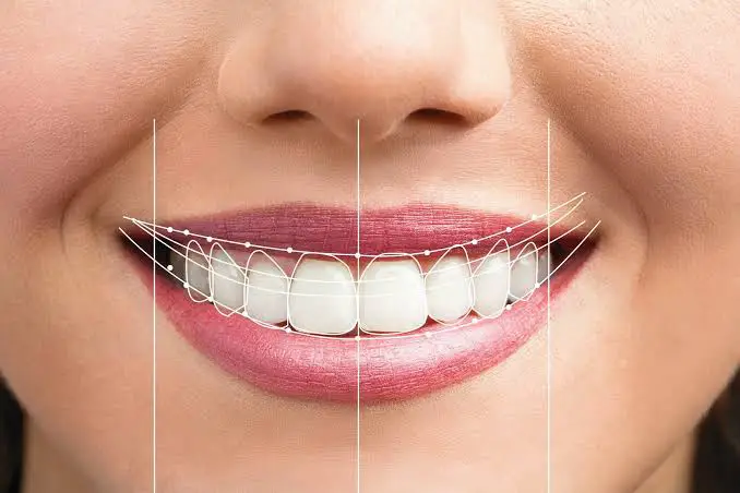 طراحی لبخند دیجیتال (DSD) چیست